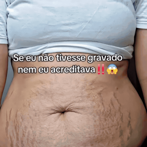 ADEUS | Adiós a las Estrías y Cicatrices